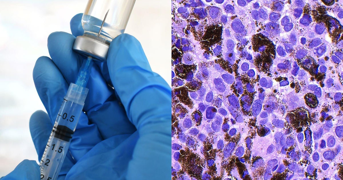 Promising mRNA Vaccine Aims to Combat Deadliest Skin Cancer